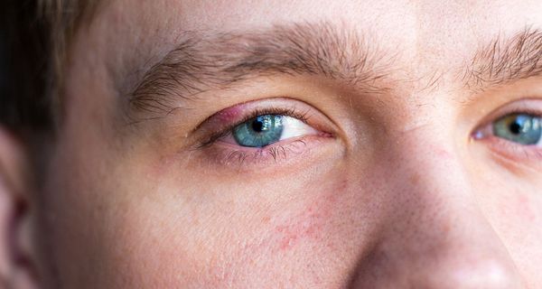 Ein Gerstenkorn ist eine schmerzhafte Augenentzündung.