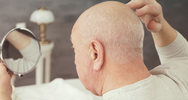 Frühzeitiger Haarausfall ist häufig erblich bedingt.