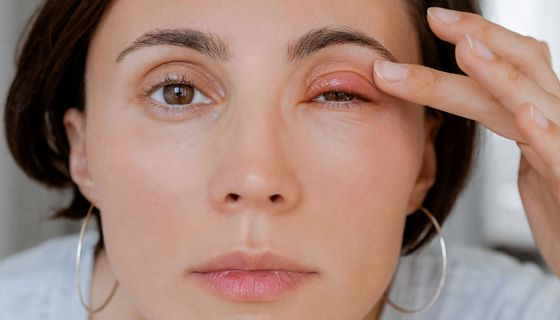 Frau, hat ein gerötetes Augenlid.