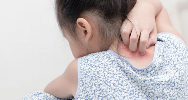 Neurodermitis ist eine häufige Hautkrankheit, die vor allem Kinder betrifft.