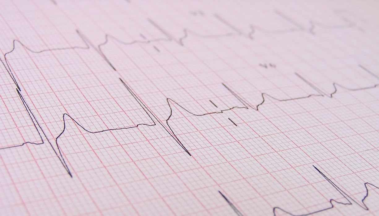 EKG-Kurve auf Millimeterpapier aufgezeichnet.