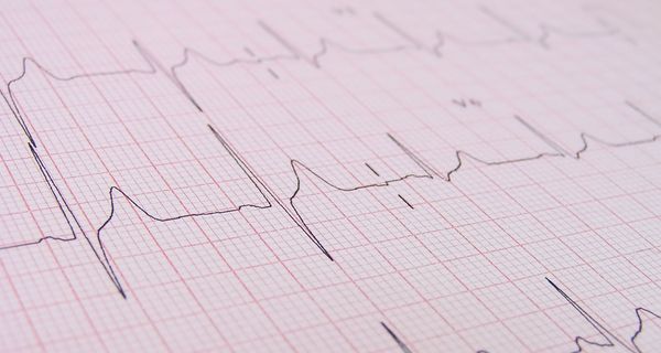 EKG-Kurve auf Millimeterpapier aufgezeichnet.