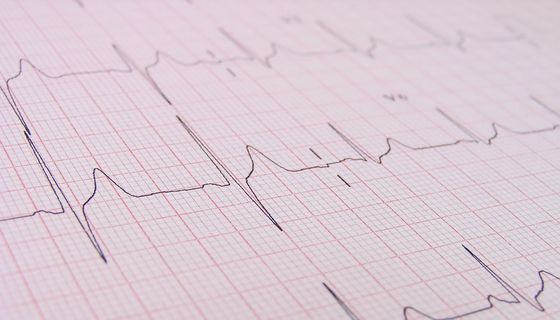 EKG-Kurve auf Millimeterpapier aufgezeichnet.