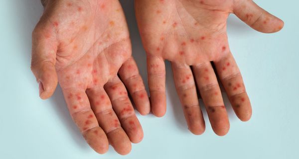 Hände mit Ausschlag.