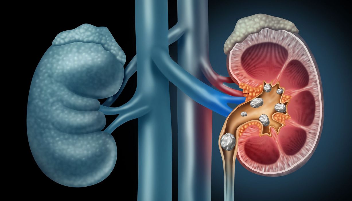 Abbildung von Nierensteinen in einer Niere.