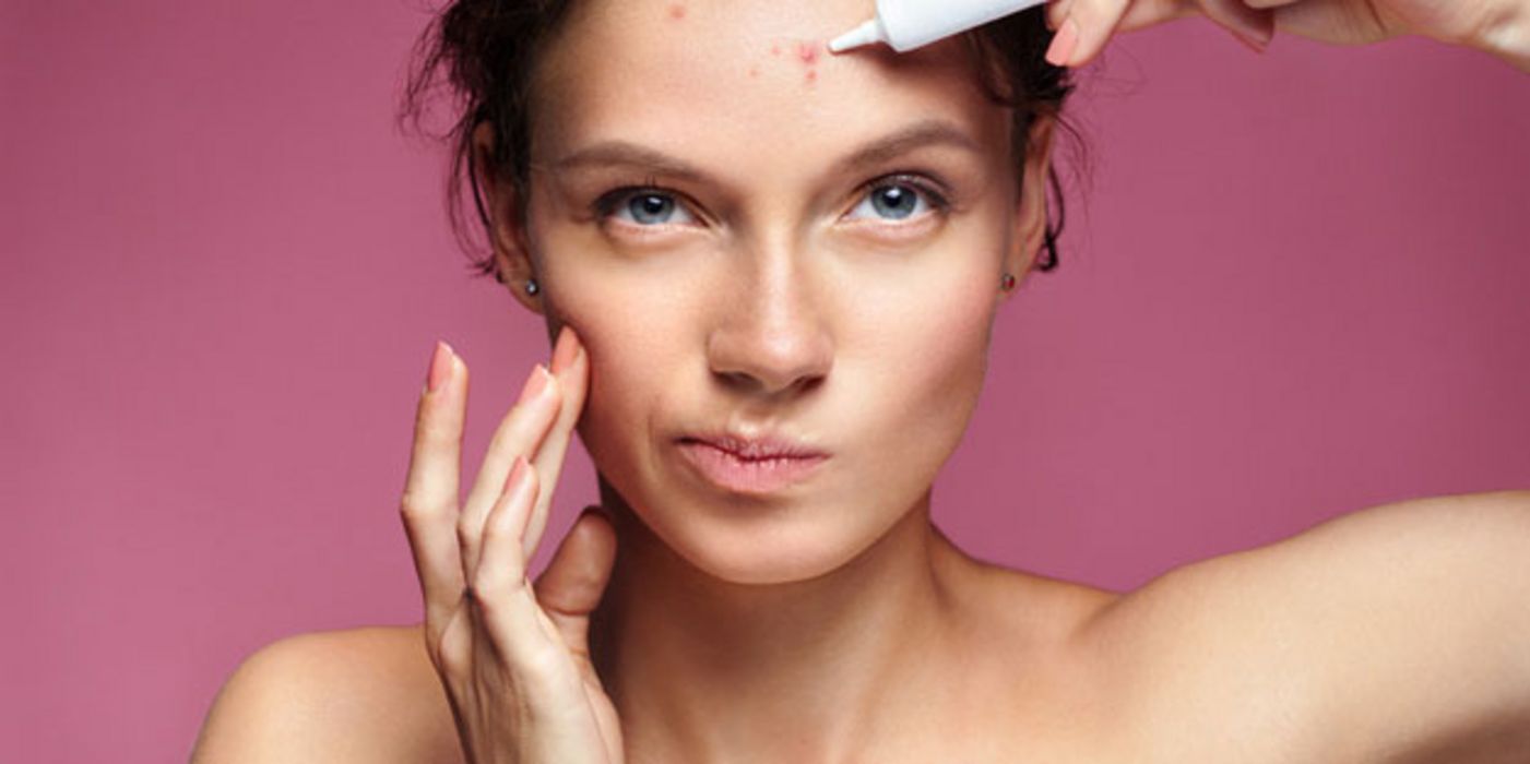 Acne comedonica und andere Arten lassen sich mit Medikamenten gut behandeln.