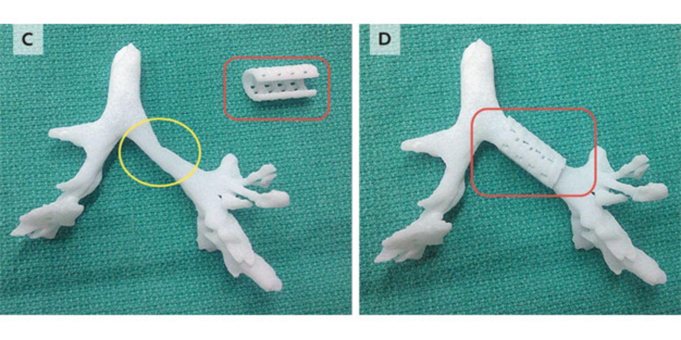 3D-Bronchus