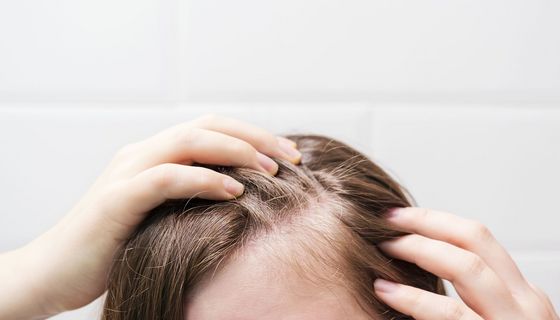 Frau mit Haarausfall.