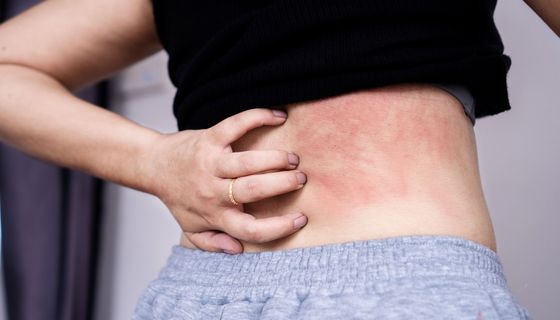 Frau, juckt sich am Rücken.