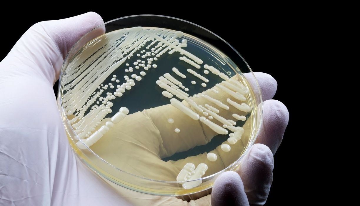 Hand eines Arztes oder Wissenschaftlers, der eine mikrobiologische Kultur des Hefepilzes Candida auris zeigt.