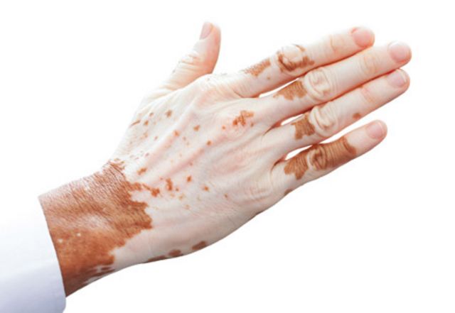 Vitiligo / Vitiligo Erkrankungen Der Haut Msd Manual Profi Ausgabe : It's pretty distinctive and is frequently diagnosed by a dermatologist simply by looking at it, often with the aid of a special light called a wood's lamp.